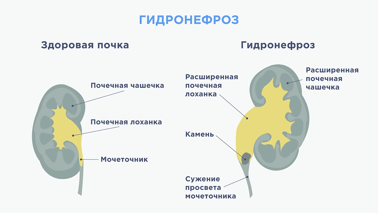 Почечная недостаточность: причины, симптомы, стадии, лечение, диета